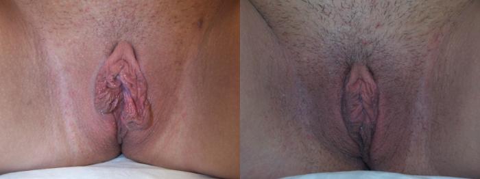 Before & After Labiaplasty Case 3269 View 1 View in Virginia Beach, VA