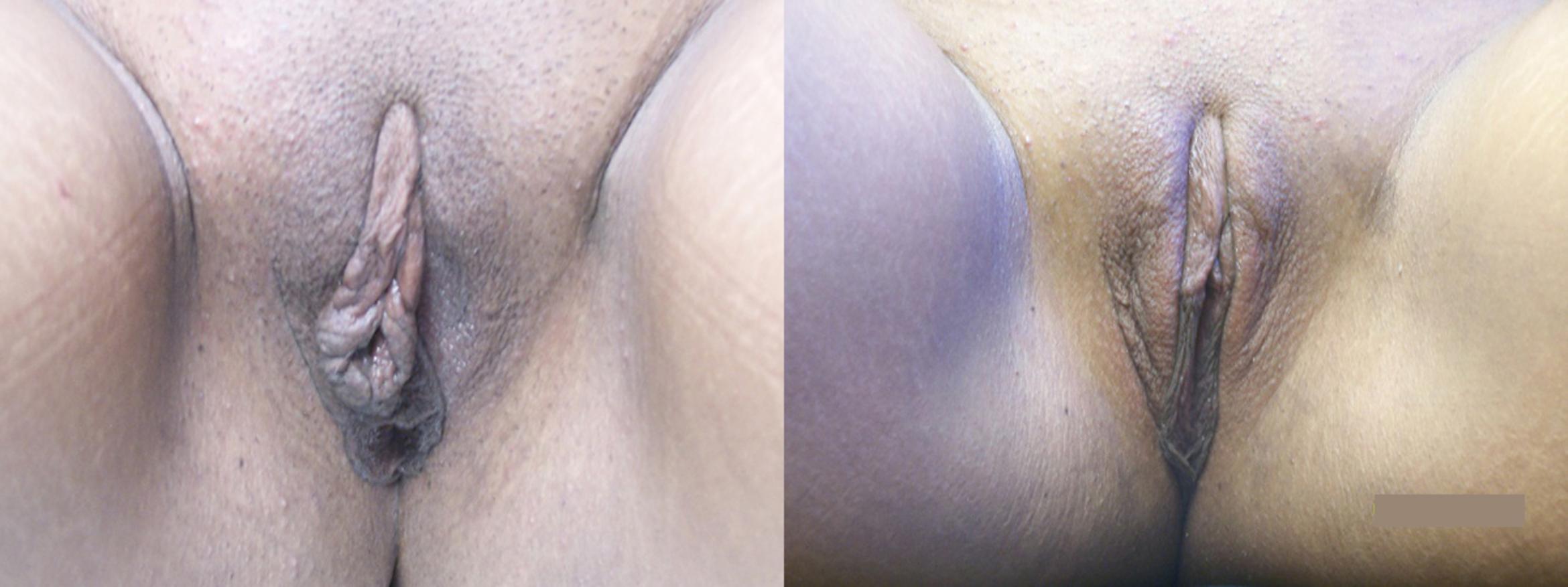 Before & After Labiaplasty Case 4416 View 1 View in Virginia Beach, VA