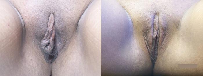Before & After Labiaplasty Case 4416 View 1 View in Virginia Beach, VA