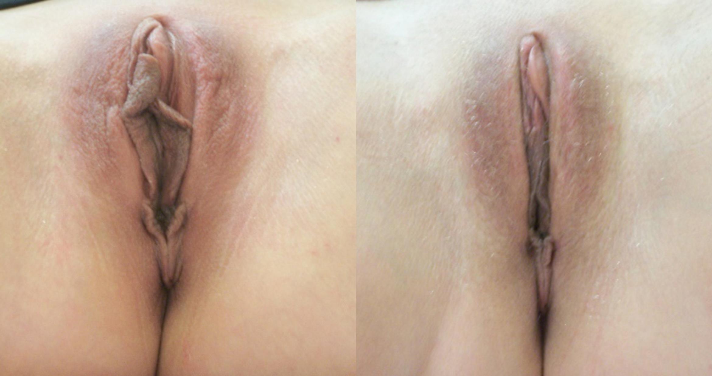 Before & After Labiaplasty Case 4419 View 1 View in Virginia Beach, VA