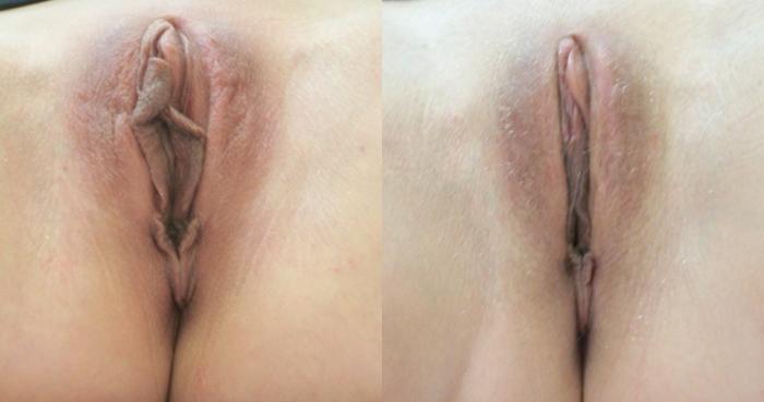 Before & After Labiaplasty Case 4419 View 1 View in Virginia Beach, VA
