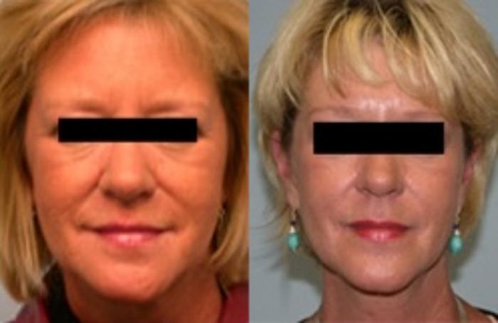 Before & After Laser Skin Resurfacing Case 2656 View 1 View in Virginia Beach, VA