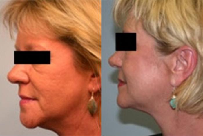 Before & After Laser Skin Resurfacing Case 2656 View 2 View in Virginia Beach, VA