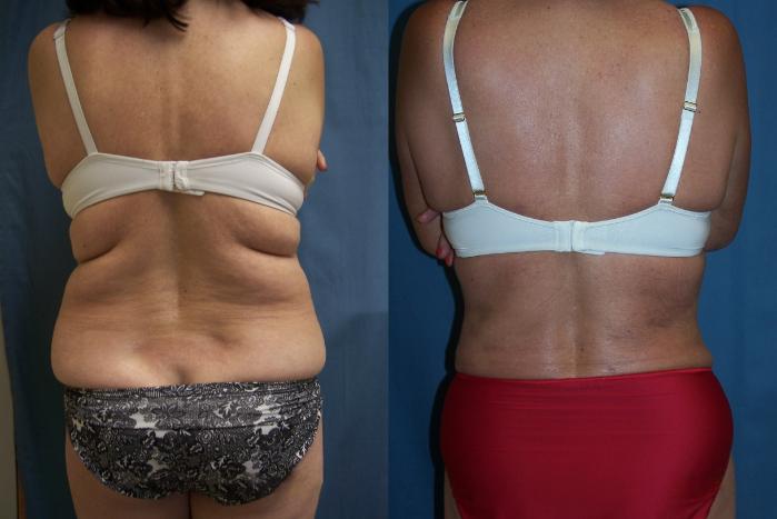 Before & After Liposuction Case 3339 View 1 View in Virginia Beach, VA