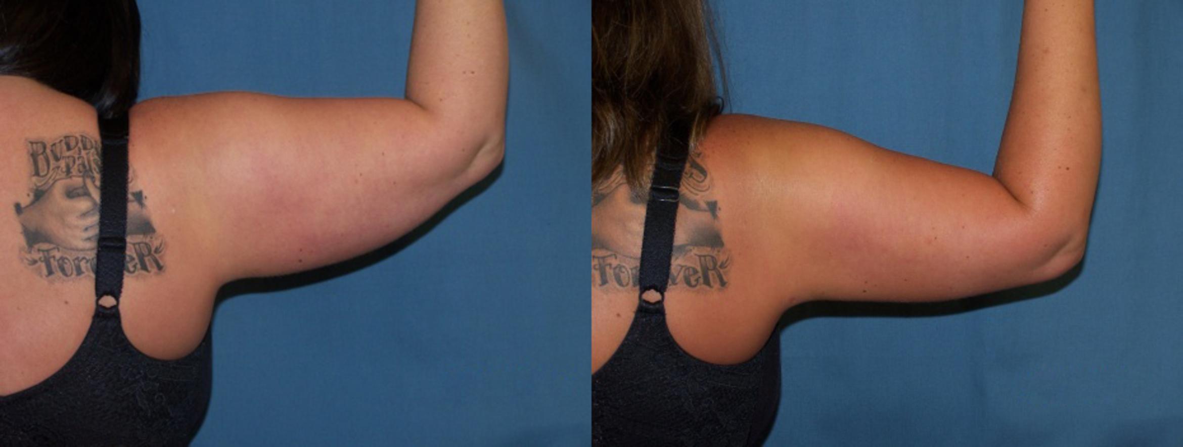Before & After Liposuction Case 3349 View 1 View in Virginia Beach, VA