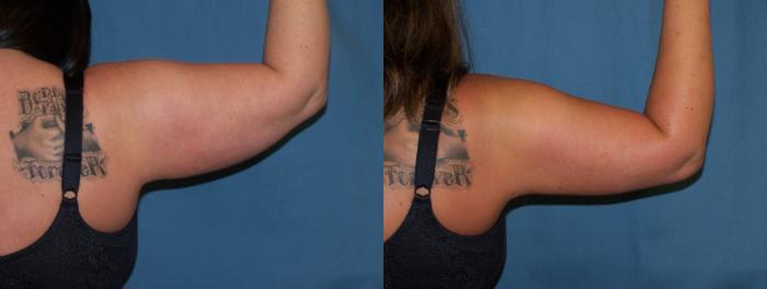 Before & After Liposuction Case 3349 View 1 View in Virginia Beach, VA