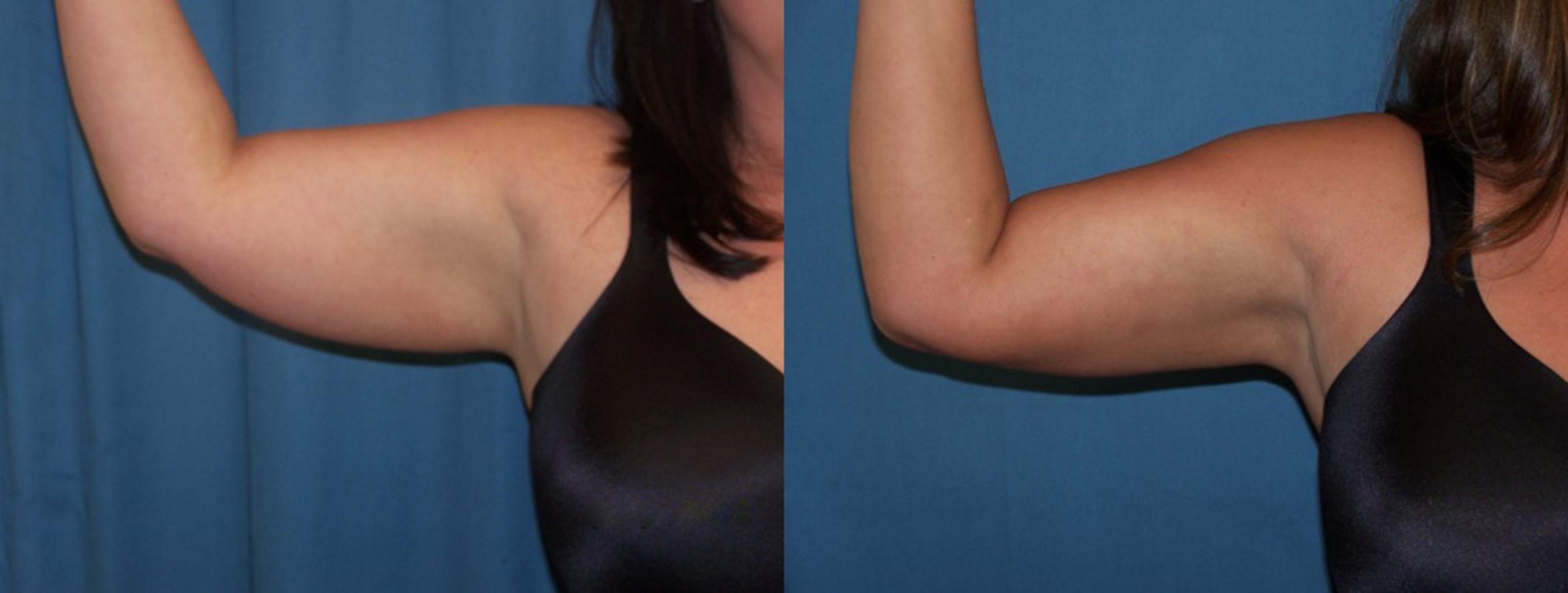 Before & After Liposuction Case 3349 View 2 View in Virginia Beach, VA