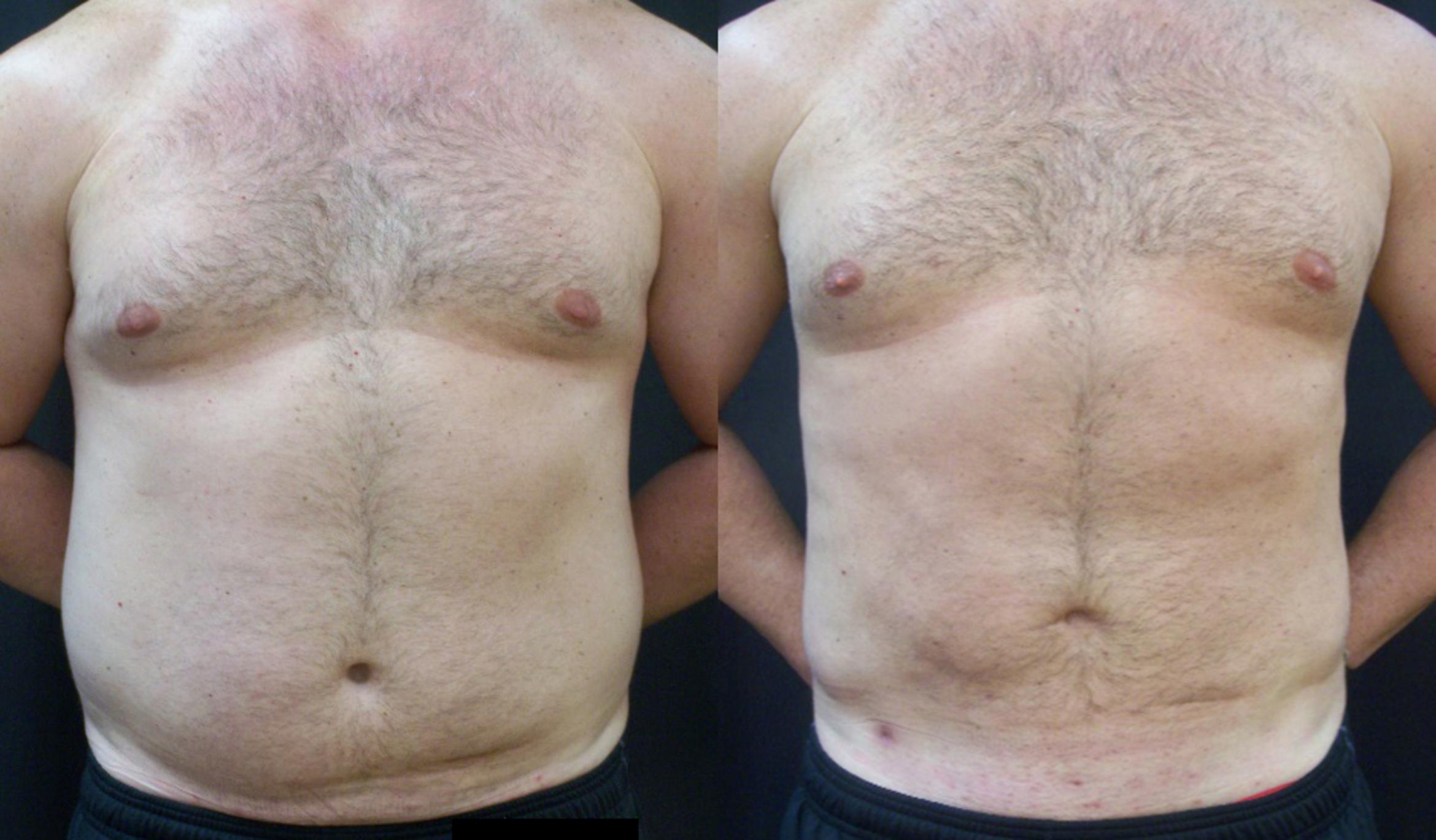 Before & After Liposuction Case 4439 View 1 View in Virginia Beach, VA
