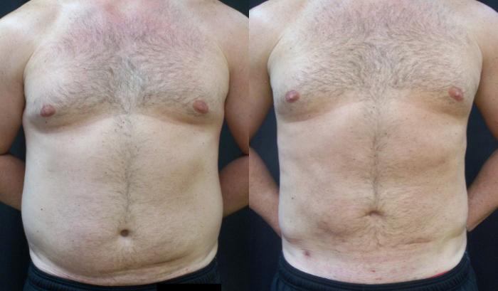 Before & After Liposuction Case 4439 View 1 View in Virginia Beach, VA