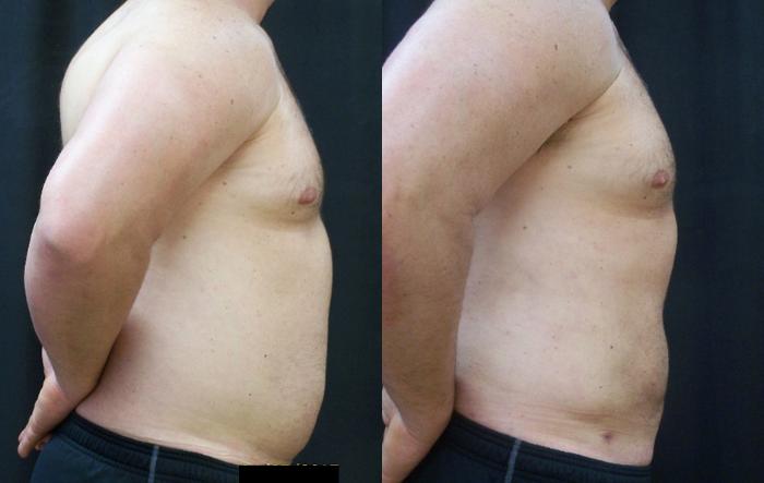 Before & After Liposuction Case 4439 View 2 View in Virginia Beach, VA