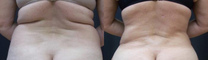 Before & After Liposuction Case 4456 View 1 View in Virginia Beach, VA