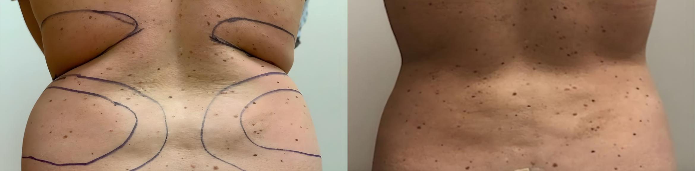 Before & After Liposuction Case 60638 Back View in Virginia Beach, VA