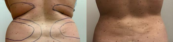 Before & After Liposuction Case 60638 Back View in Virginia Beach, VA