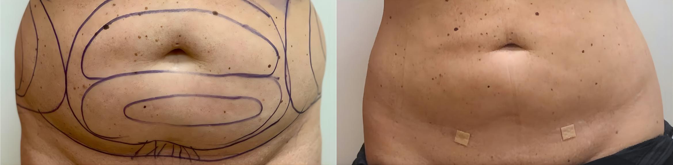 Before & After Liposuction Case 60638 Front View in Virginia Beach, VA