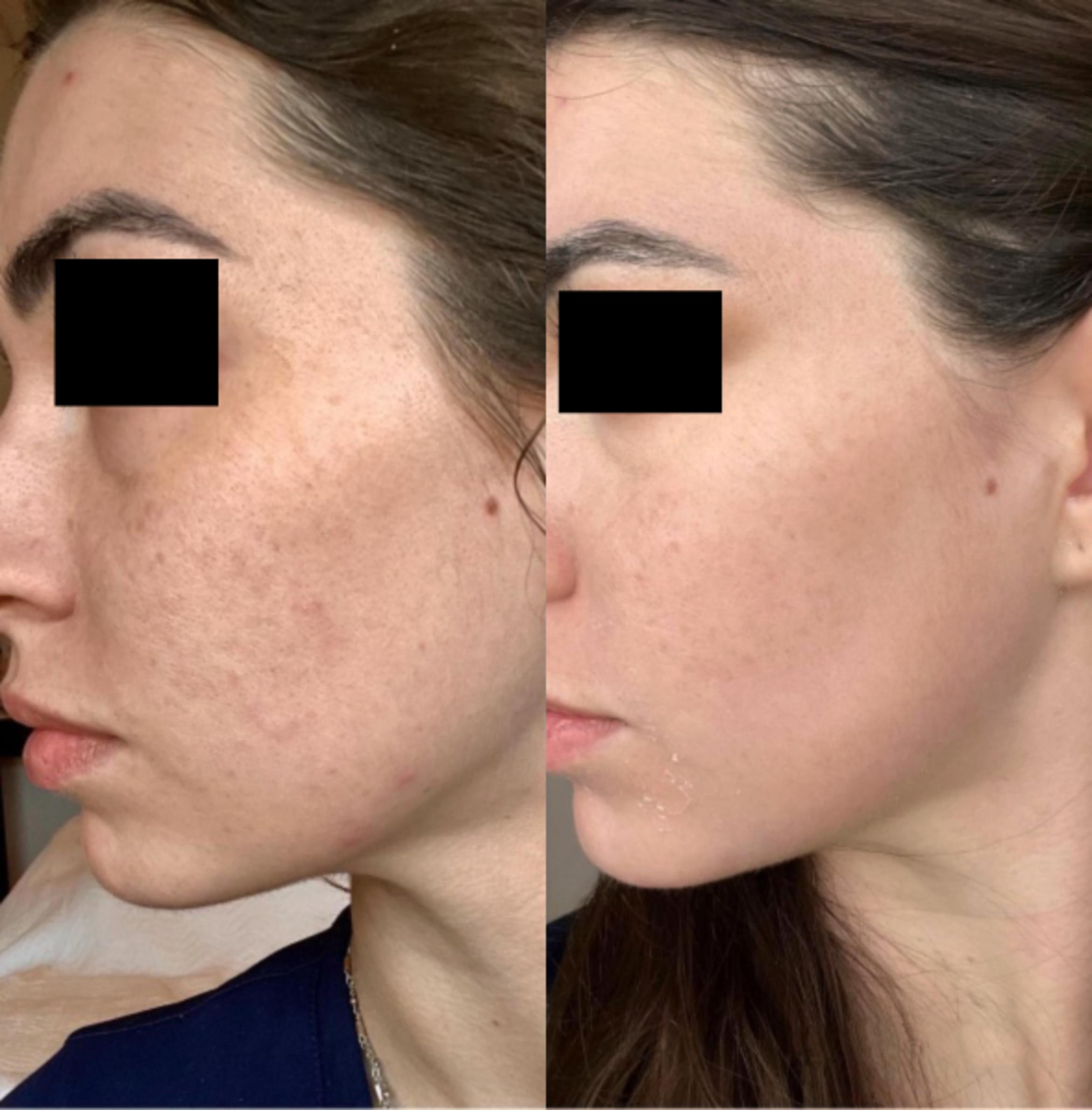 Before & After Microneedling with PRP Case 22808 View 1 View in Virginia Beach, VA