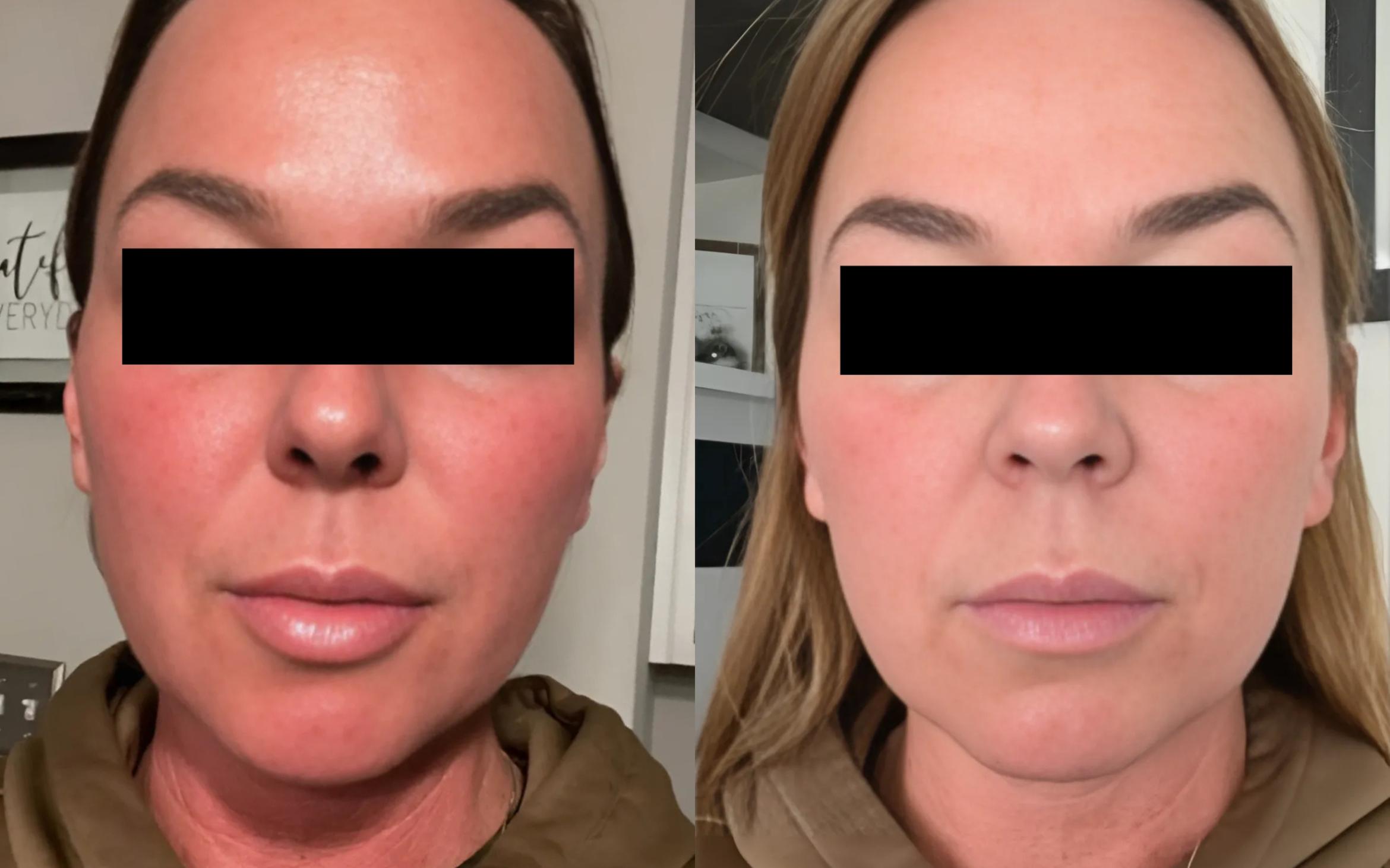 Before & After Microneedling with PRP Case 60625 6 Hours After / 24 Hours After View in Virginia Beach, VA