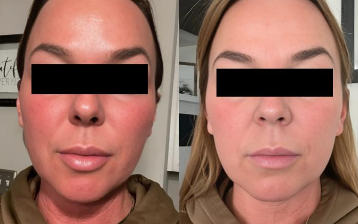 Before & After Microneedling with PRP Case 60625 6 Hours After / 24 Hours After View in Virginia Beach, VA