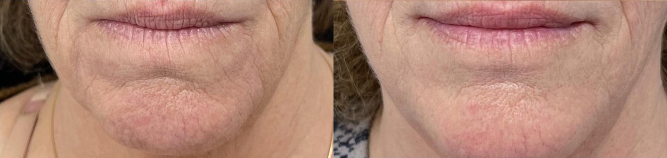 Before & After Microneedling with PRP Case 60664 Front View in Virginia Beach, VA