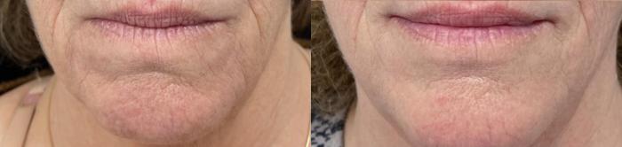 Before & After Microneedling with PRP Case 60664 Front View in Virginia Beach, VA