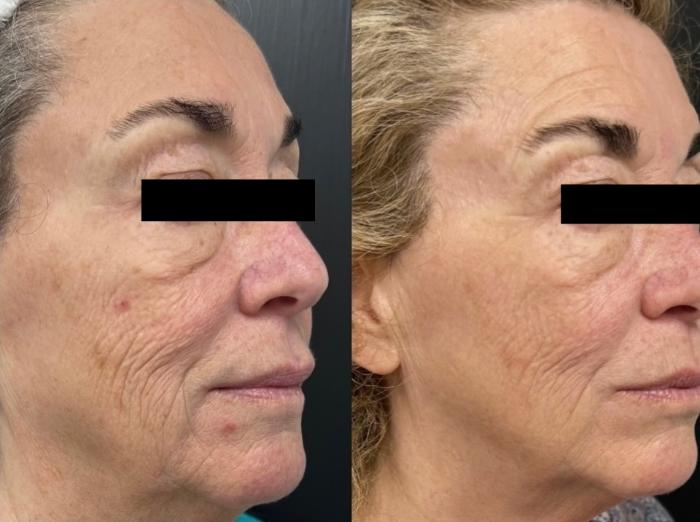 Before & After Microneedling with PRP Case 60667 Left Side View in Virginia Beach, VA