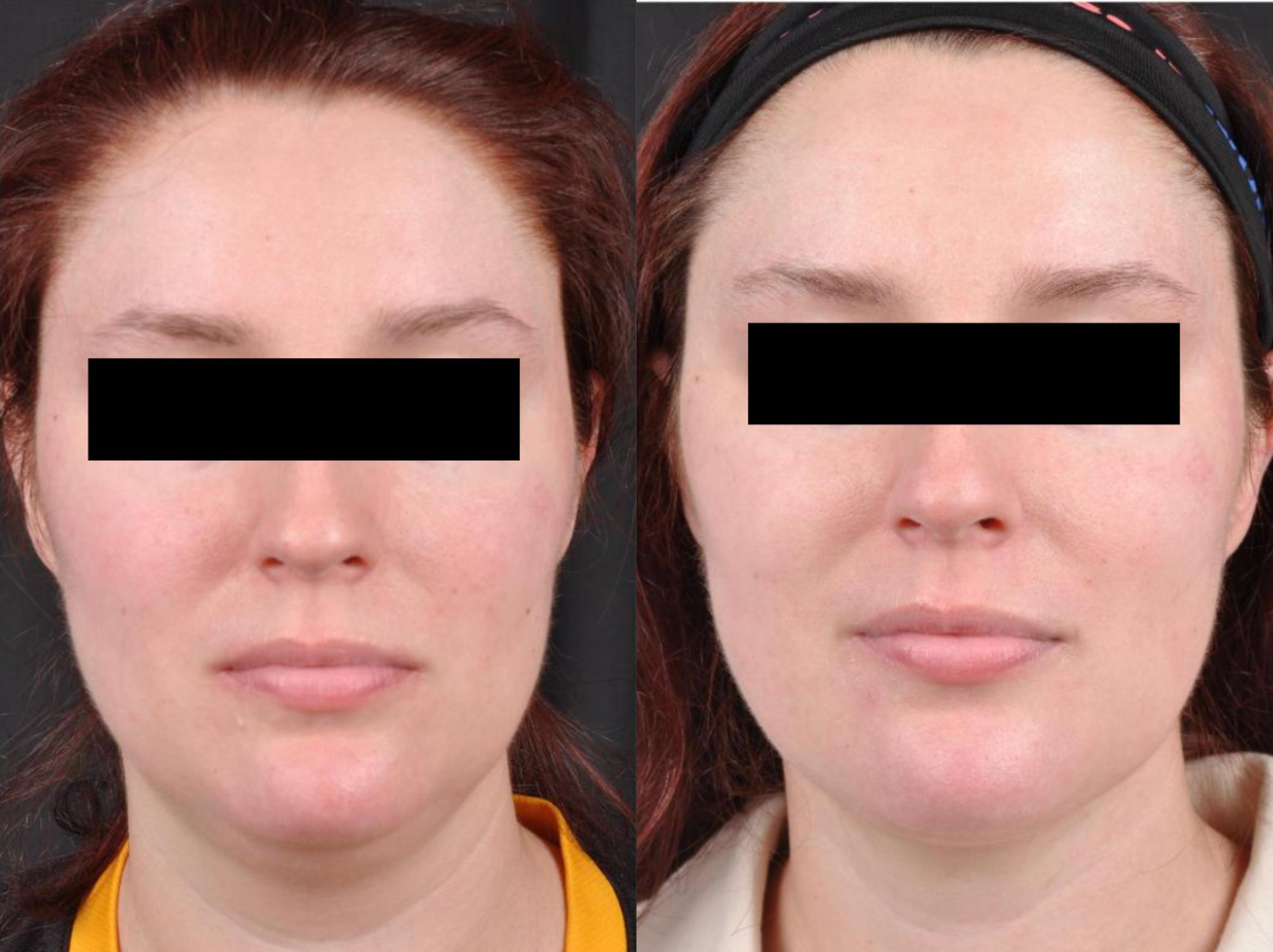 Before & After MyEllevate® Case 10 View 1 View in Virginia Beach, VA