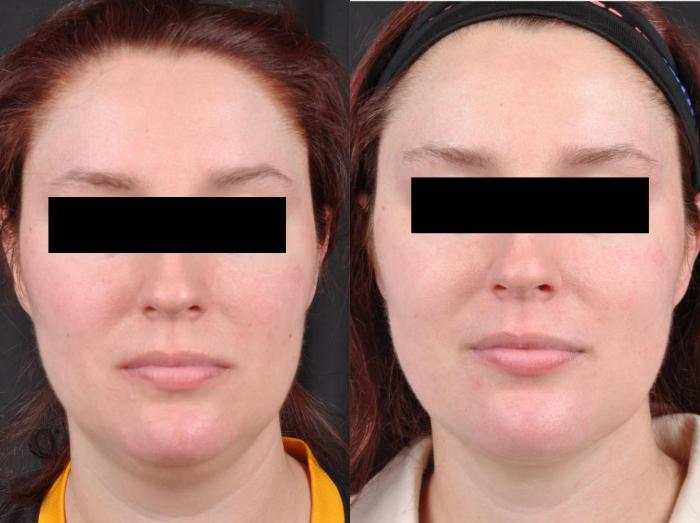 Before & After MyEllevate® Case 10 View 1 View in Virginia Beach, VA