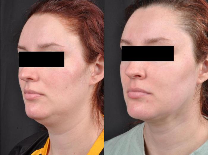 Before & After MyEllevate® Case 10 View 2 View in Virginia Beach, VA