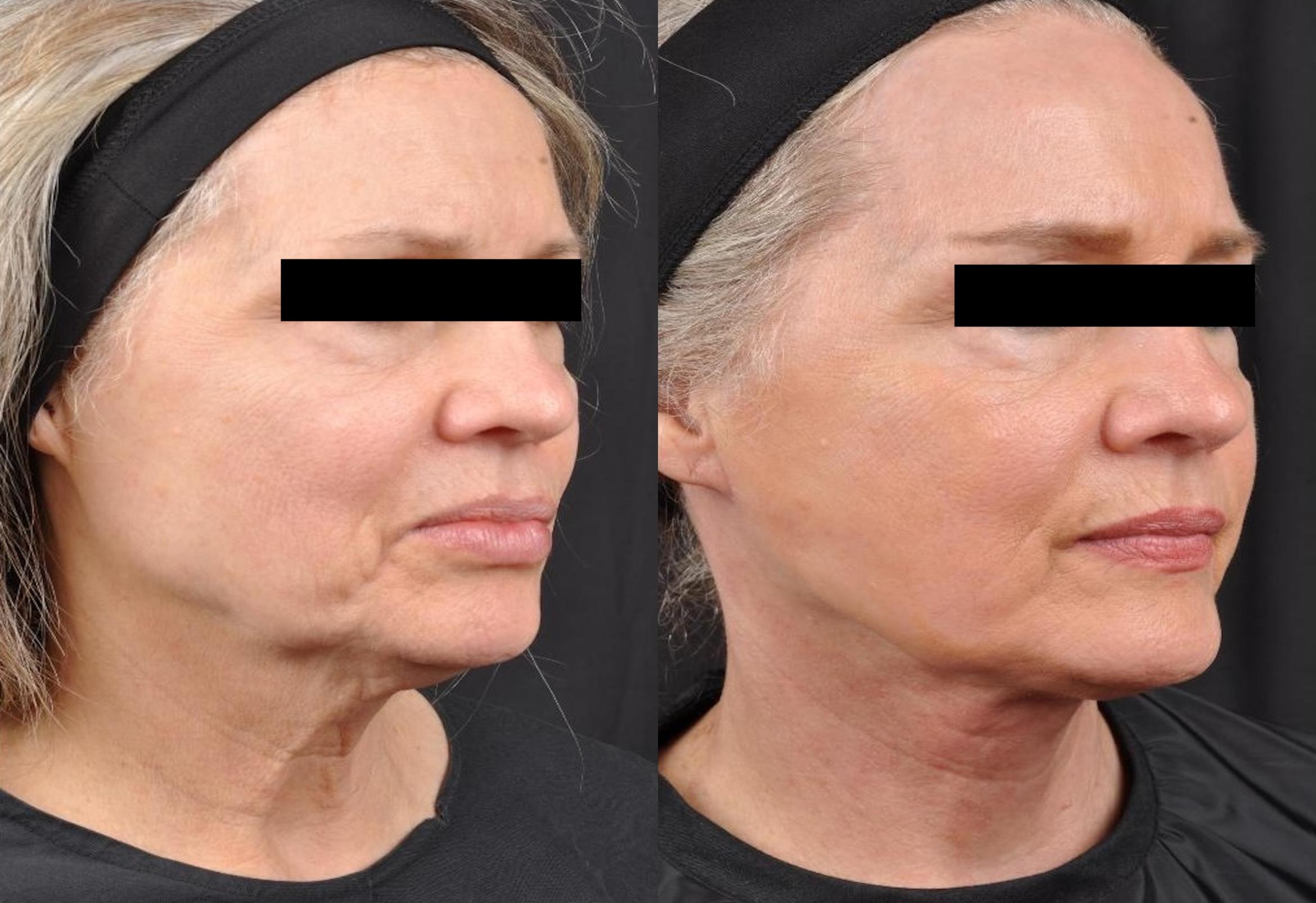 Before & After MyEllevate® Case 3 View 1 View in Virginia Beach, VA