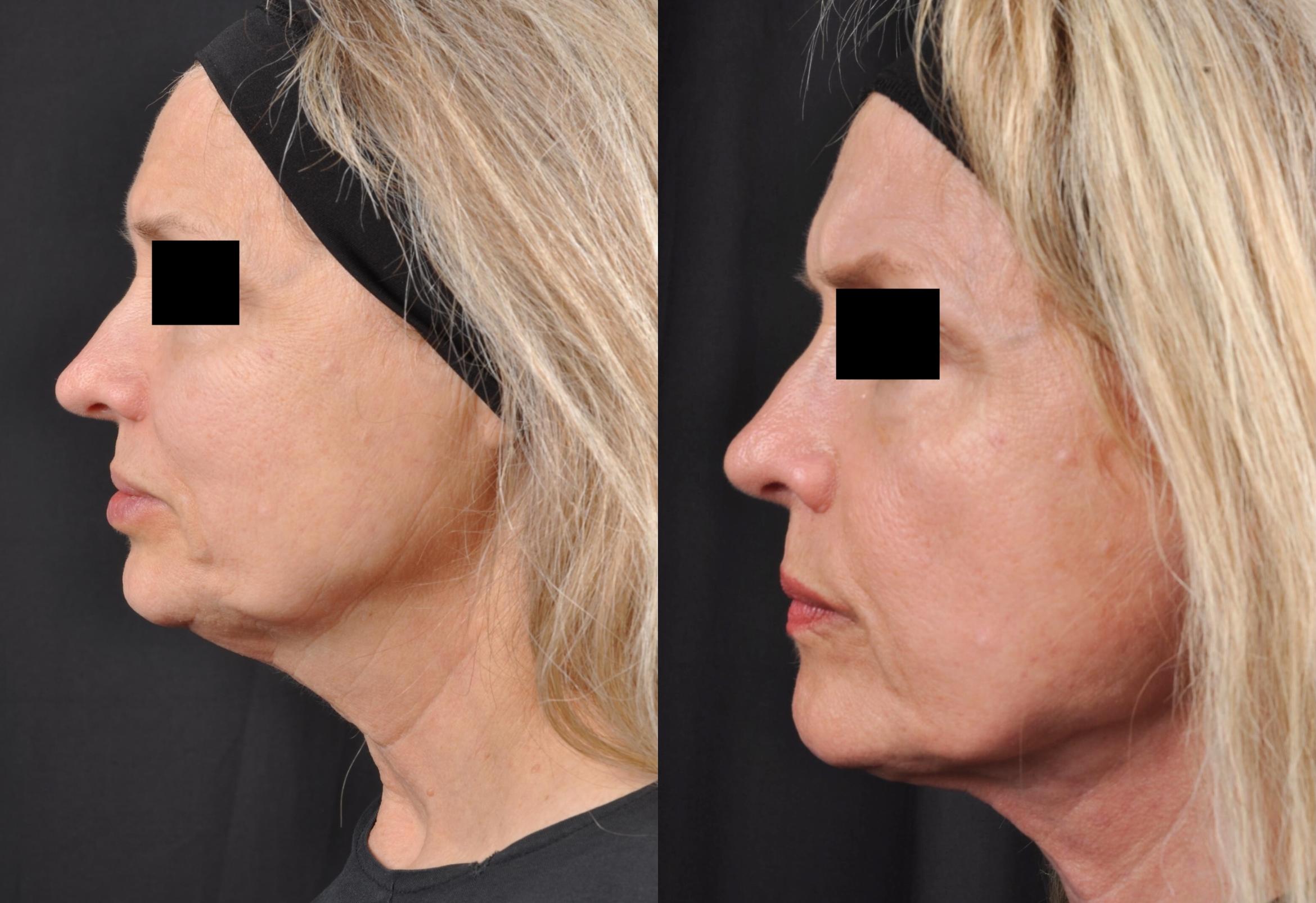 Before & After MyEllevate® Case 3 View 2 View in Virginia Beach, VA