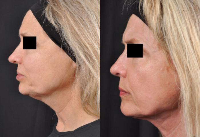Before & After MyEllevate® Case 3 View 2 View in Virginia Beach, VA