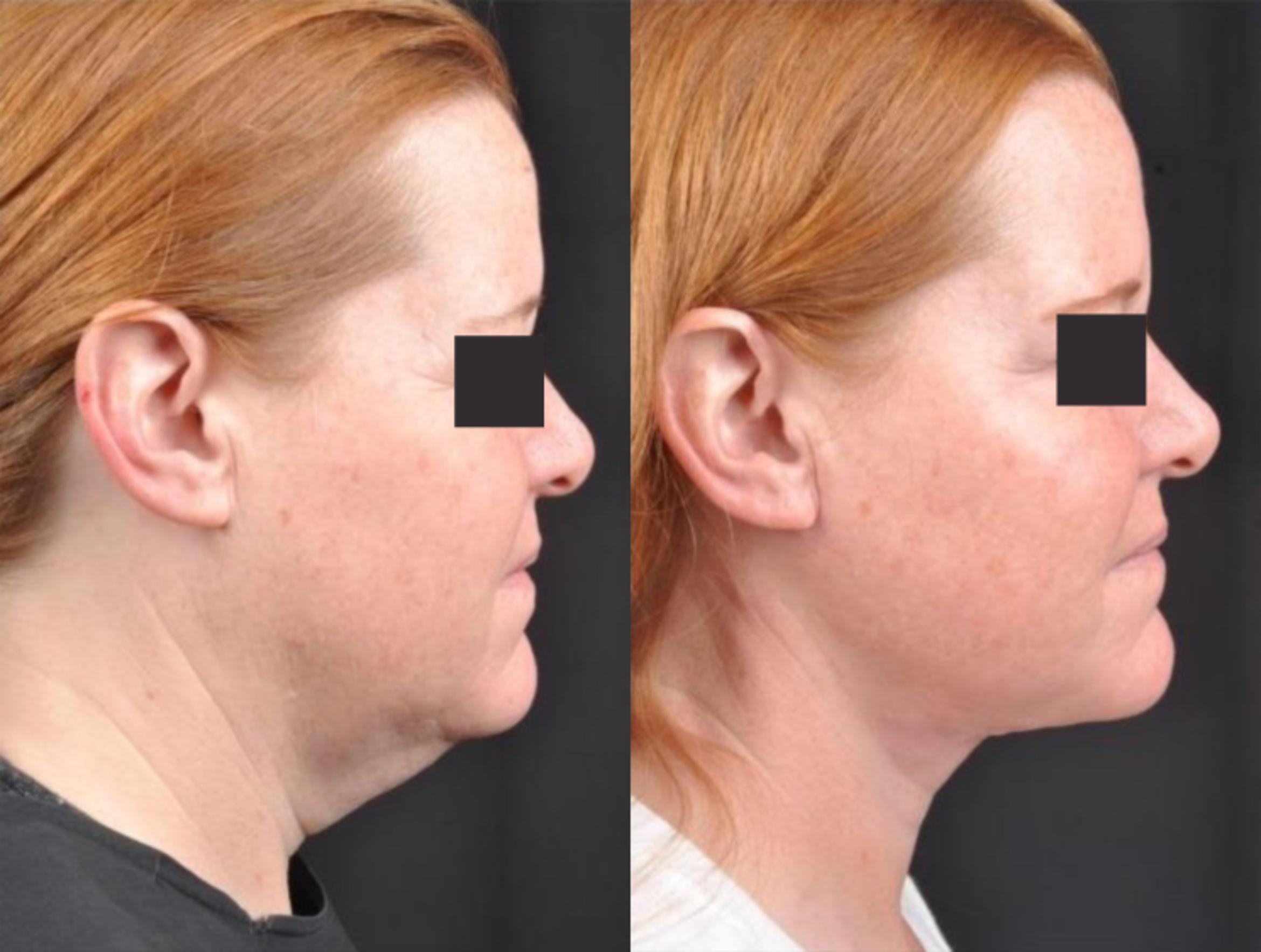 Before & After MyEllevate® Case 4 View 1 View in Virginia Beach, VA