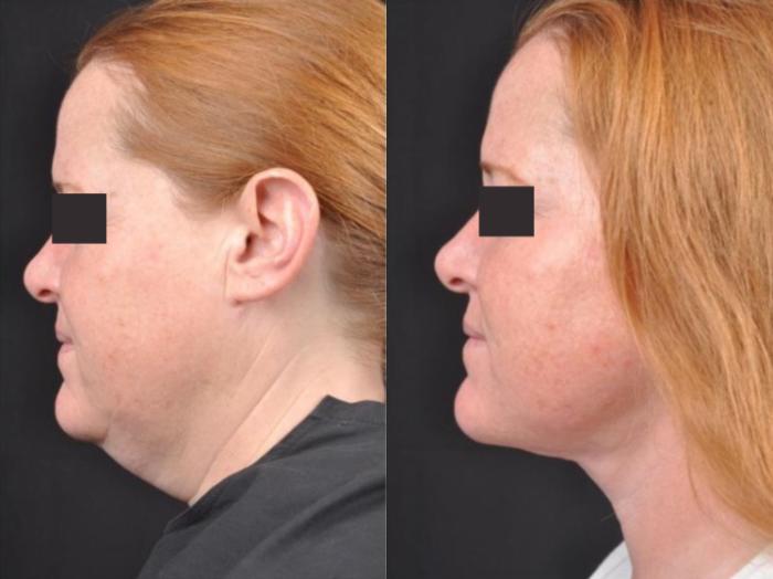 Before & After MyEllevate® Case 4 View 2 View in Virginia Beach, VA