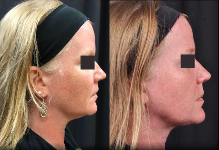 Before & After MyEllevate® Case 5 View 1 View in Virginia Beach, VA