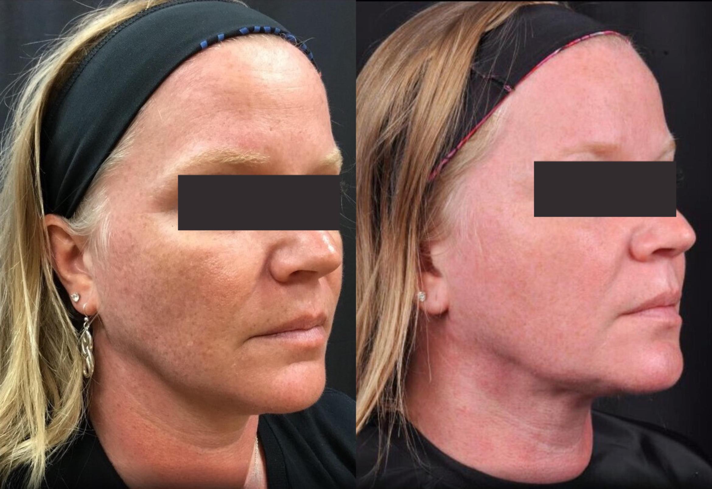 Before & After MyEllevate® Case 5 View 2 View in Virginia Beach, VA