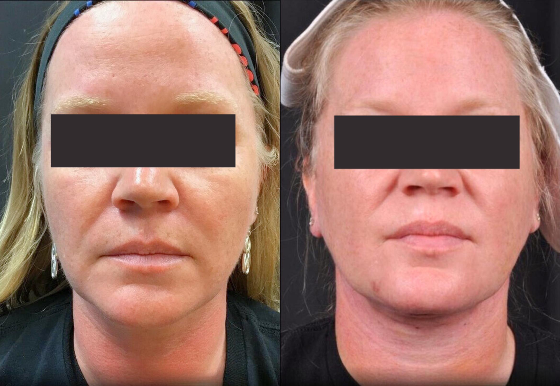 Before & After MyEllevate® Case 5 View 3 View in Virginia Beach, VA
