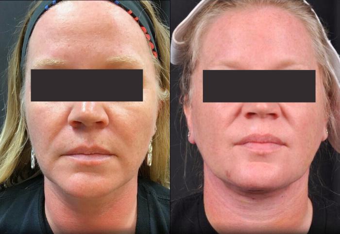 Before & After MyEllevate® Case 5 View 3 View in Virginia Beach, VA