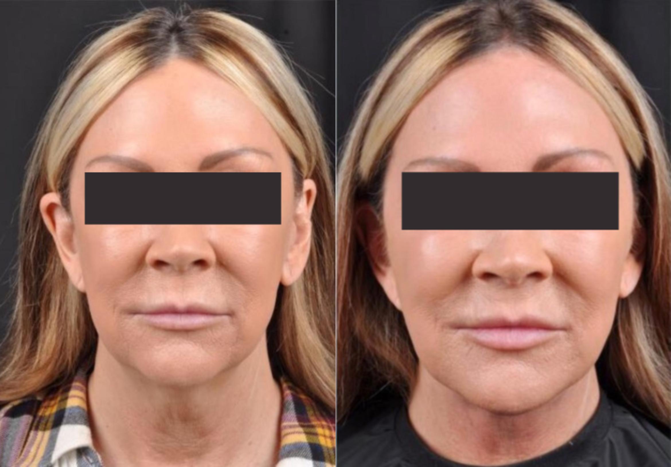 Before & After MyEllevate® Case 6 View 1 View in Virginia Beach, VA