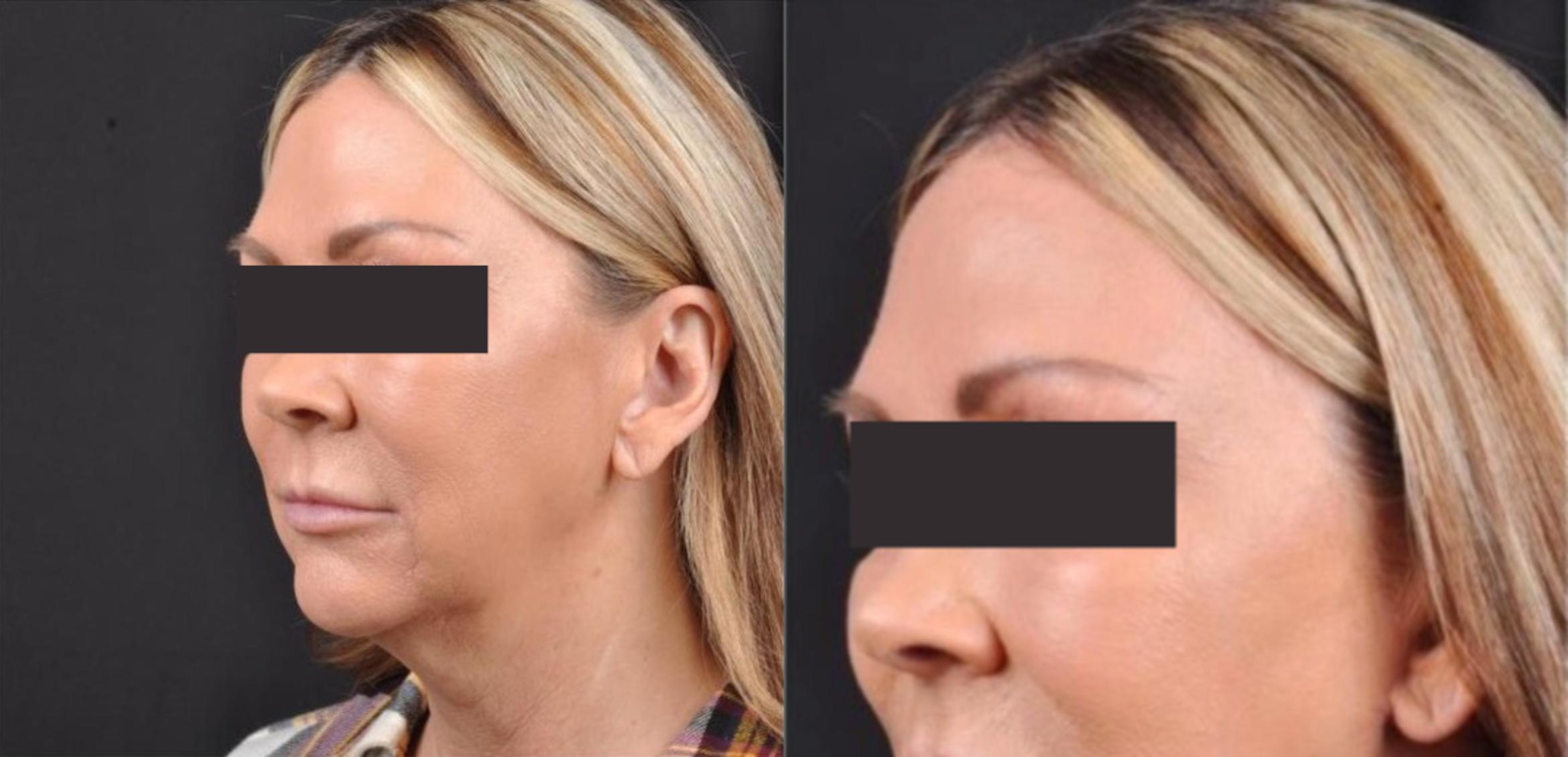 Before & After MyEllevate® Case 6 View 2 View in Virginia Beach, VA
