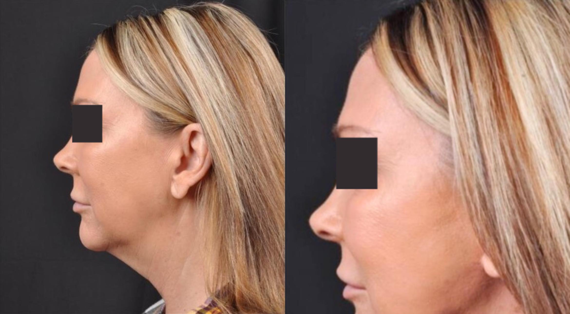Before & After MyEllevate® Case 6 View 3 View in Virginia Beach, VA