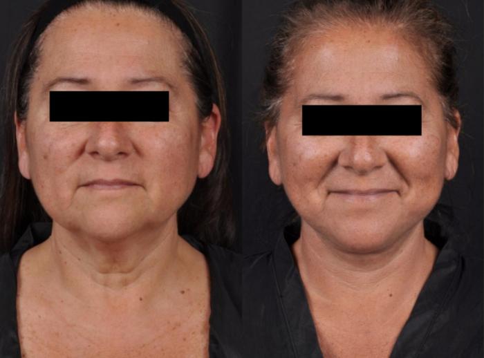 Before & After MyEllevate® Case 60630 Front View in Virginia Beach, VA