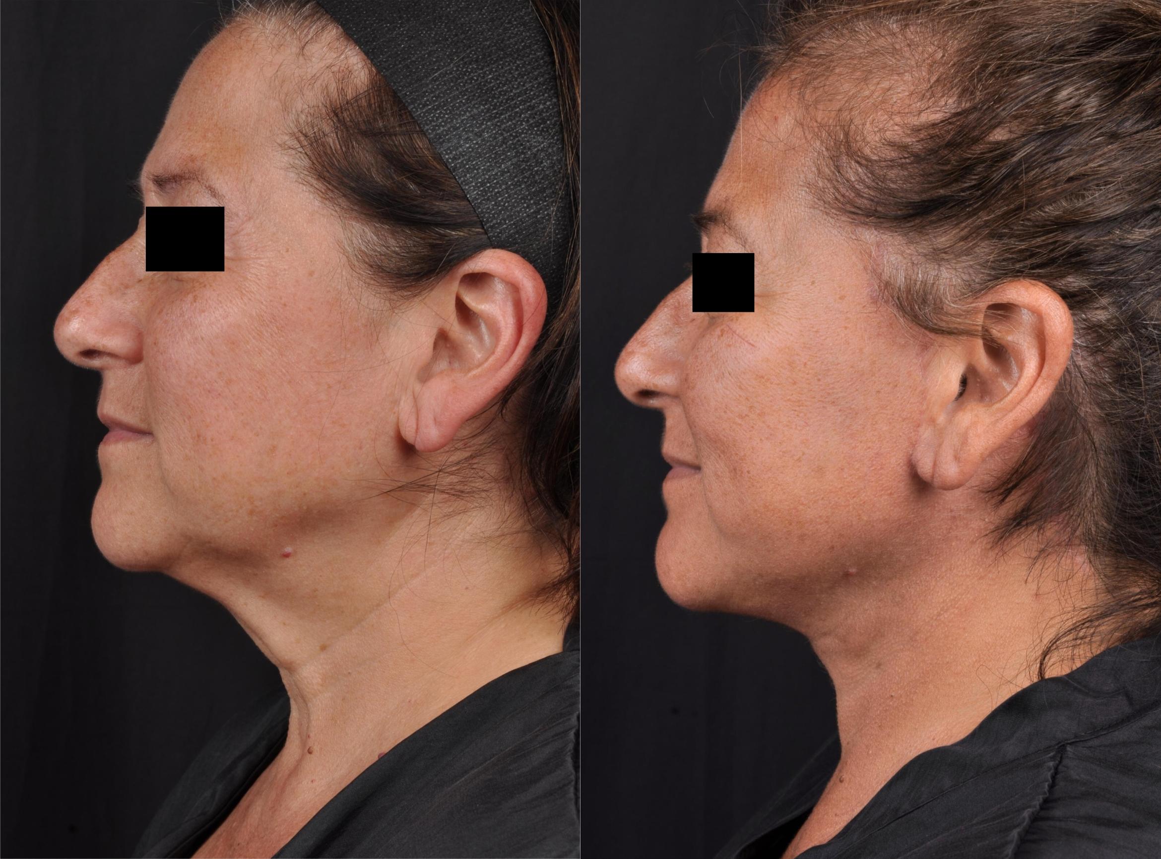 Before & After MyEllevate® Case 60630 Right Side View in Virginia Beach, VA