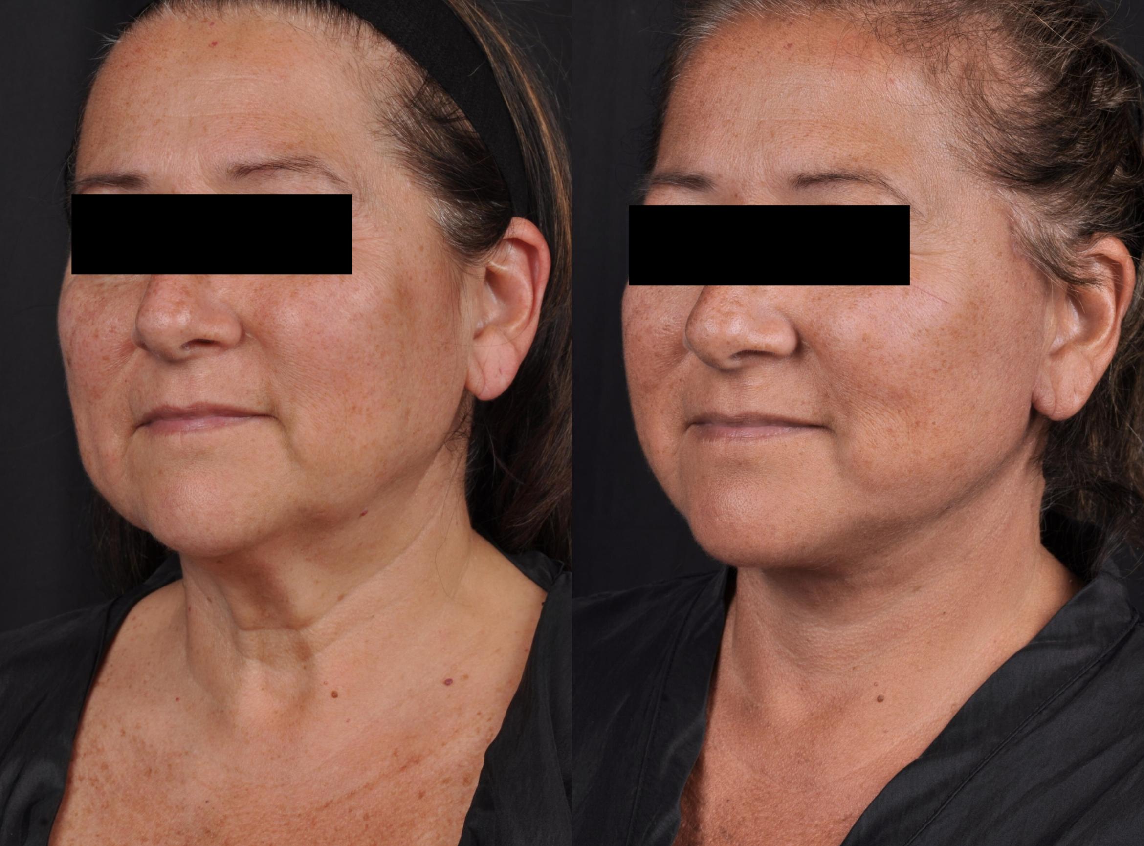 Before & After MyEllevate® Case 60630 Three-quarter View in Virginia Beach, VA