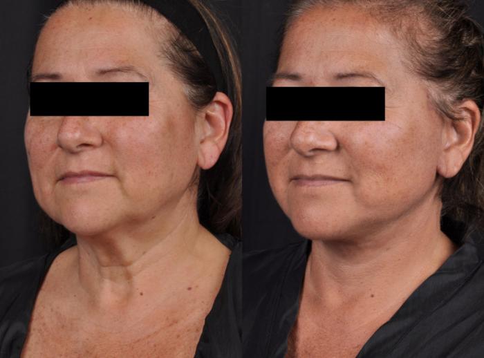 Before & After MyEllevate® Case 60630 Three-quarter View in Virginia Beach, VA