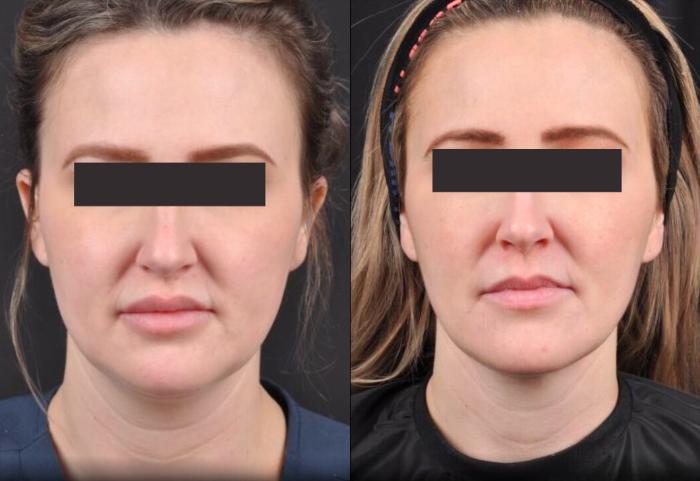 Before & After MyEllevate® Case 7 View 1 View in Virginia Beach, VA