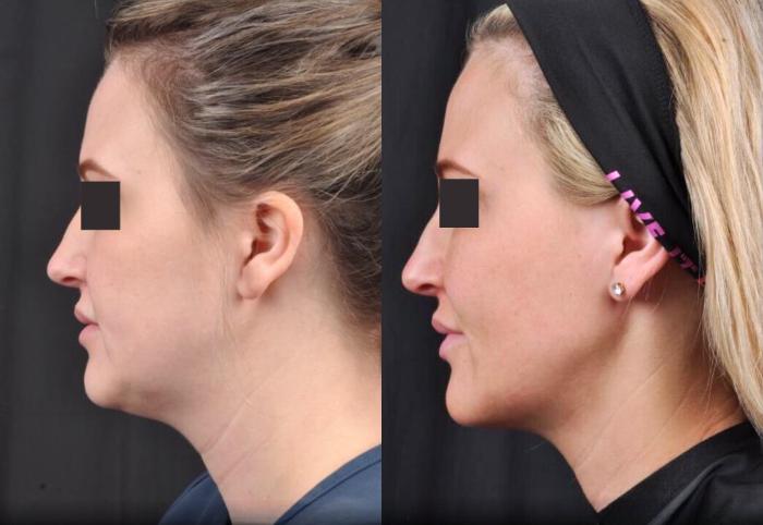 Before & After MyEllevate® Case 7 View 2 View in Virginia Beach, VA