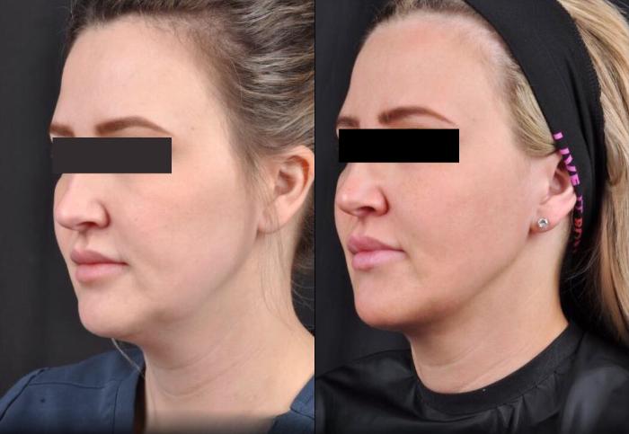 Before & After MyEllevate® Case 7 View 3 View in Virginia Beach, VA