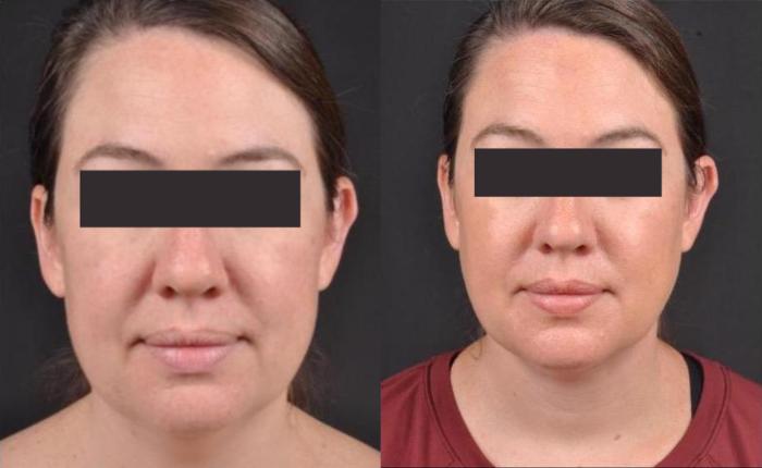Before & After MyEllevate® Case 9 View 1 View in Virginia Beach, VA