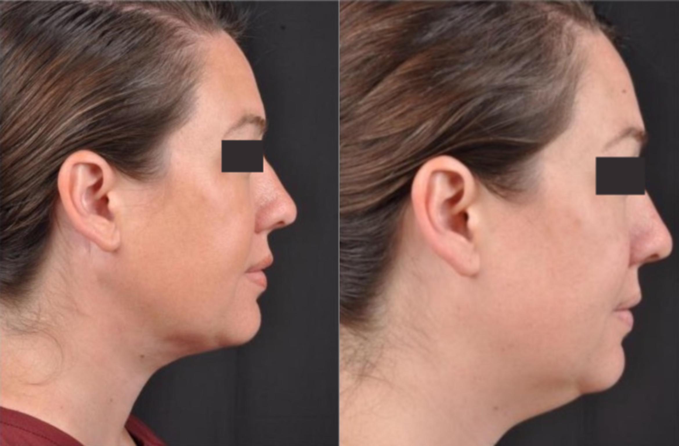 Before & After MyEllevate® Case 9 View 2 View in Virginia Beach, VA