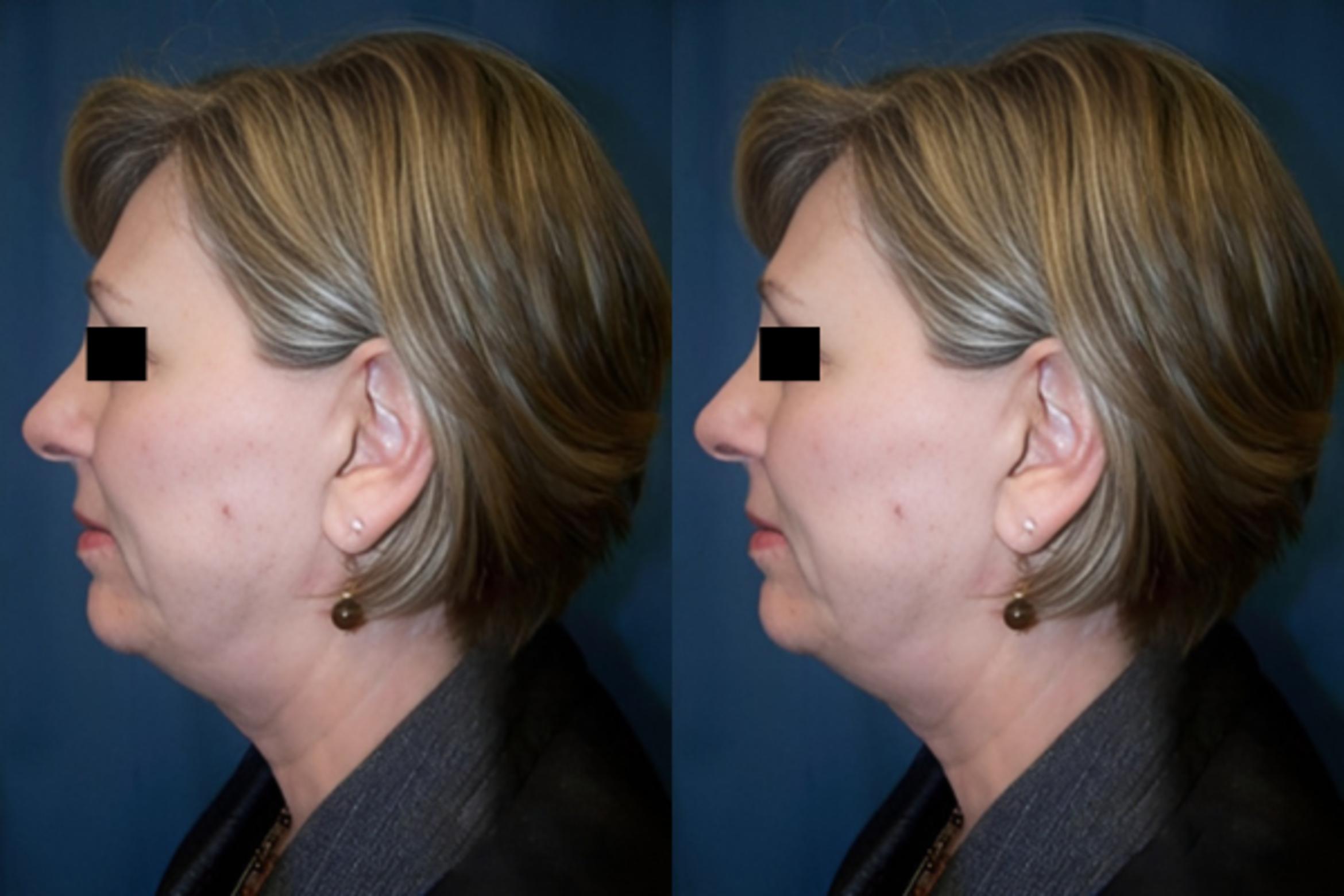 Before & After Necklift Case 2868 View 1 View in Virginia Beach, VA