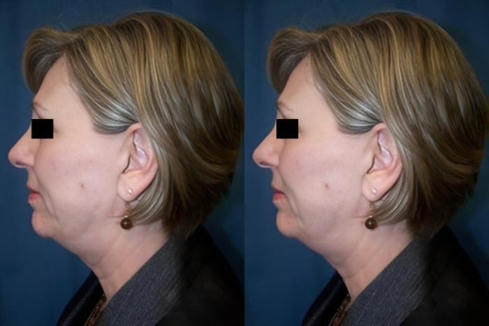 Before & After Necklift Case 2868 View 1 View in Virginia Beach, VA